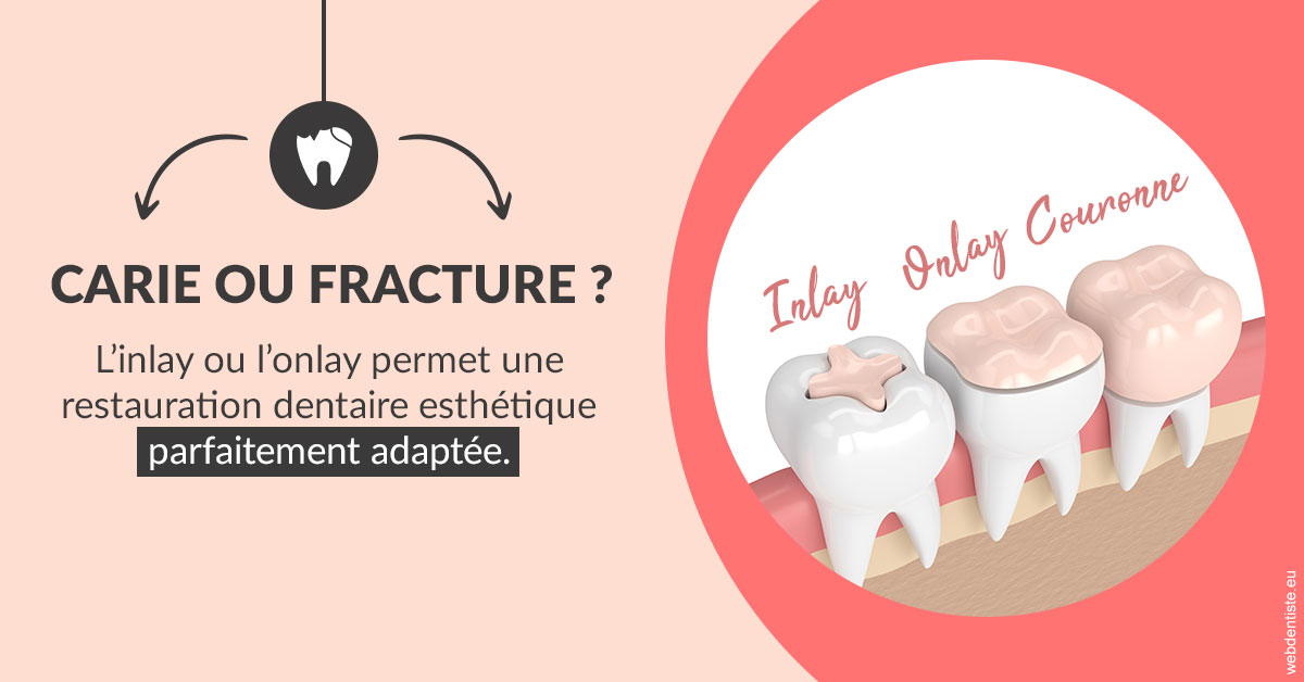 https://dr-benjamin-simonnet.chirurgiens-dentistes.fr/T2 2023 - Carie ou fracture 2