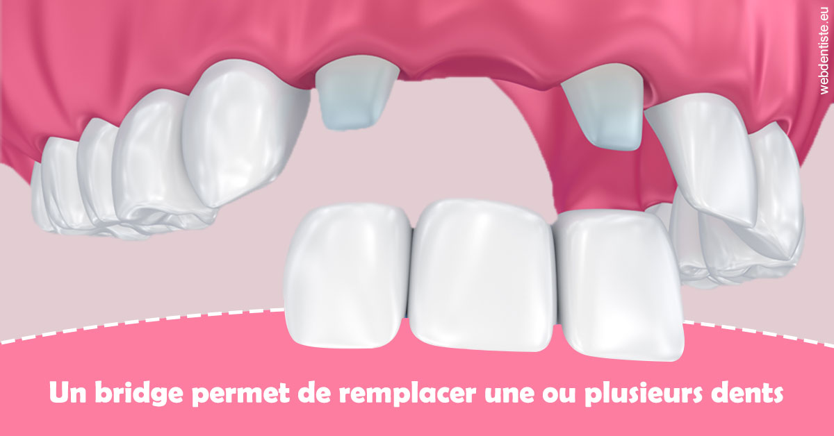 https://dr-benjamin-simonnet.chirurgiens-dentistes.fr/Bridge remplacer dents 2