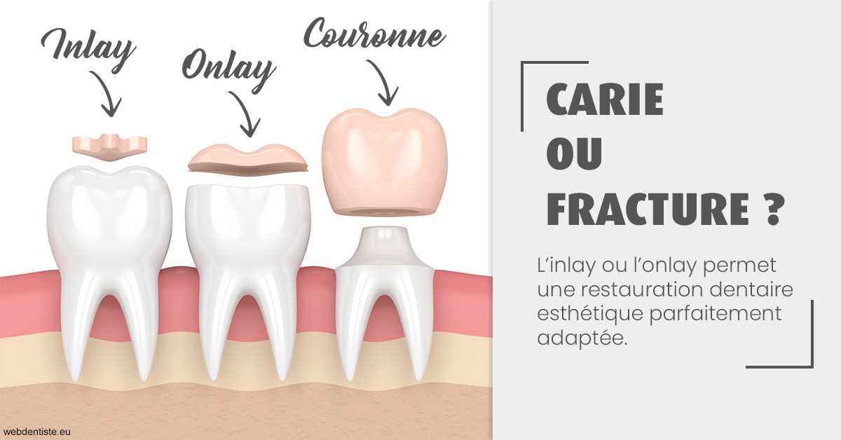 https://dr-benjamin-simonnet.chirurgiens-dentistes.fr/T2 2023 - Carie ou fracture 1