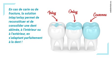 https://dr-benjamin-simonnet.chirurgiens-dentistes.fr/L'INLAY ou l'ONLAY