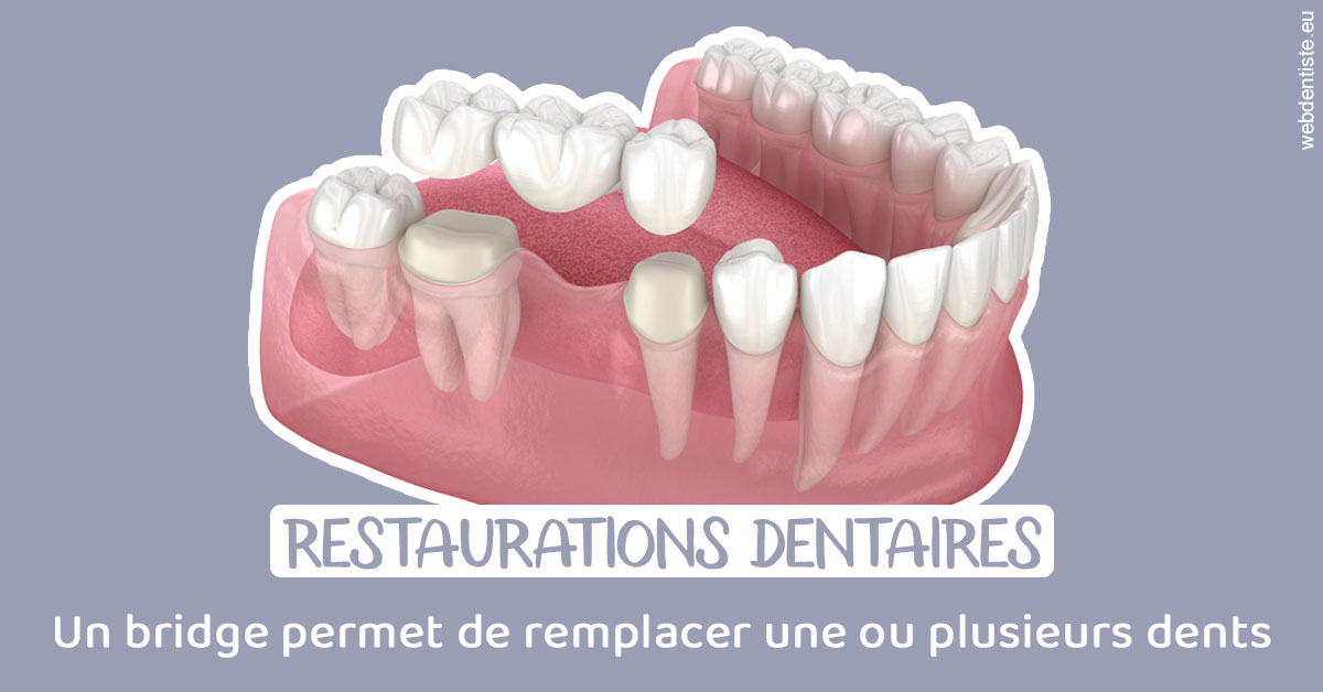 https://dr-benjamin-simonnet.chirurgiens-dentistes.fr/Bridge remplacer dents 1