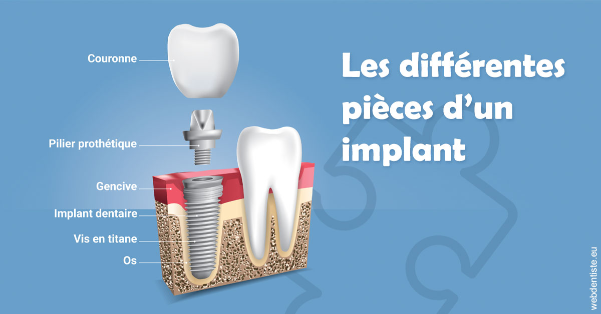 https://dr-benjamin-simonnet.chirurgiens-dentistes.fr/Les différentes pièces d’un implant 1